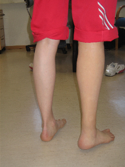 lower limbs prosthesis